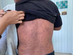 Prevalensi Kusta di Sulawesi Barat Masih Tinggi, Dinkes Perkuat Deteksi Dini dan Pengobatan